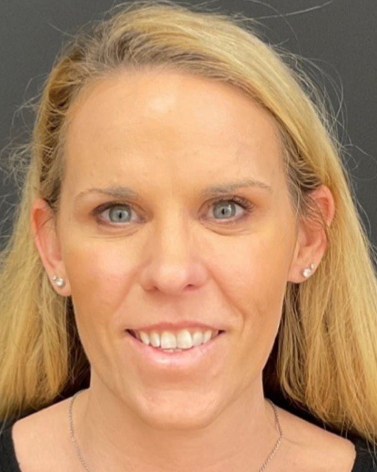 Botox after photo of CSPS patient — smoother forehead and glabella — Brentwood TN