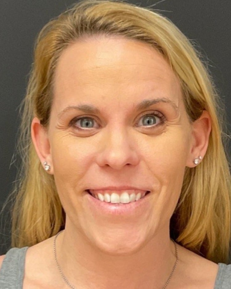 Botox before photo of CSPS patient — forehead and glabella lines — Brentwood TN