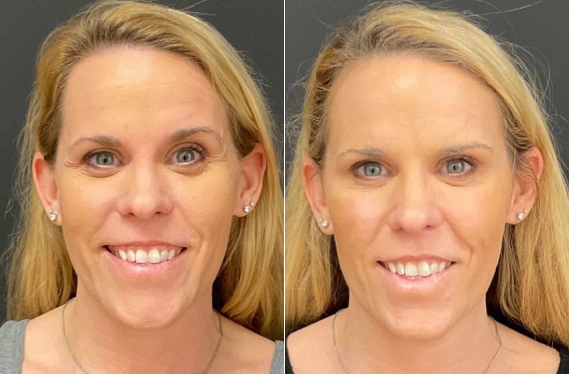 Botox before and after photos — CSPS patient with Kaylan Lady, FNP-C — Brentwood TN