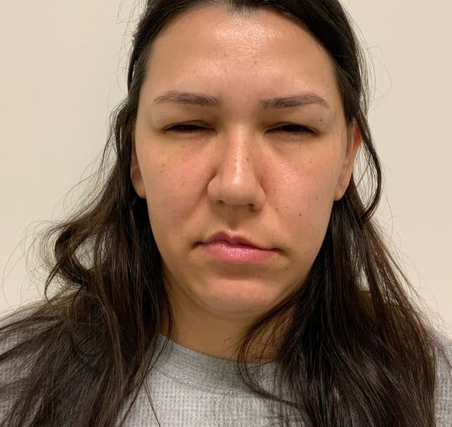 Botox after photo, smoothed glabella frown — Case 94, Cool Springs Plastic Surgery, Brentwood TN