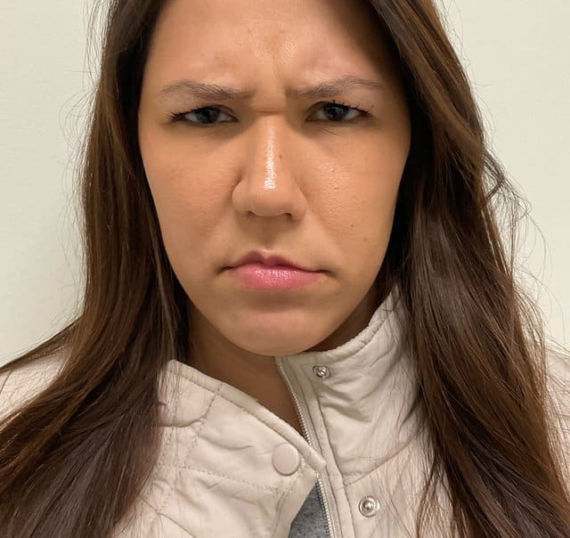 Botox before photo, glabella frown lines — Case 94, Cool Springs Plastic Surgery, Brentwood TN