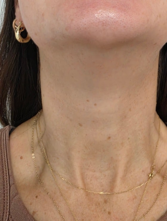Neurotoxin neck treatment after photo — Teresa Safford, Case 98, Cool Springs Plastic Surgery, Brentwood TN