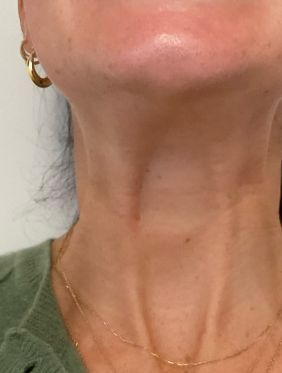 Neurotoxin neck treatment before photo — Teresa Safford, Case 98, Cool Springs Plastic Surgery, Brentwood TN