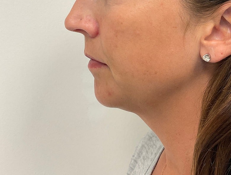 Chin filler after photo, improved chin projection — Chrissy Handly, Case 67, Cool Springs Plastic Surgery, Brentwood TN