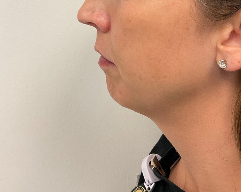 Chin filler before photo, side profile — Chrissy Handly, Case 67, Cool Springs Plastic Surgery, Brentwood TN