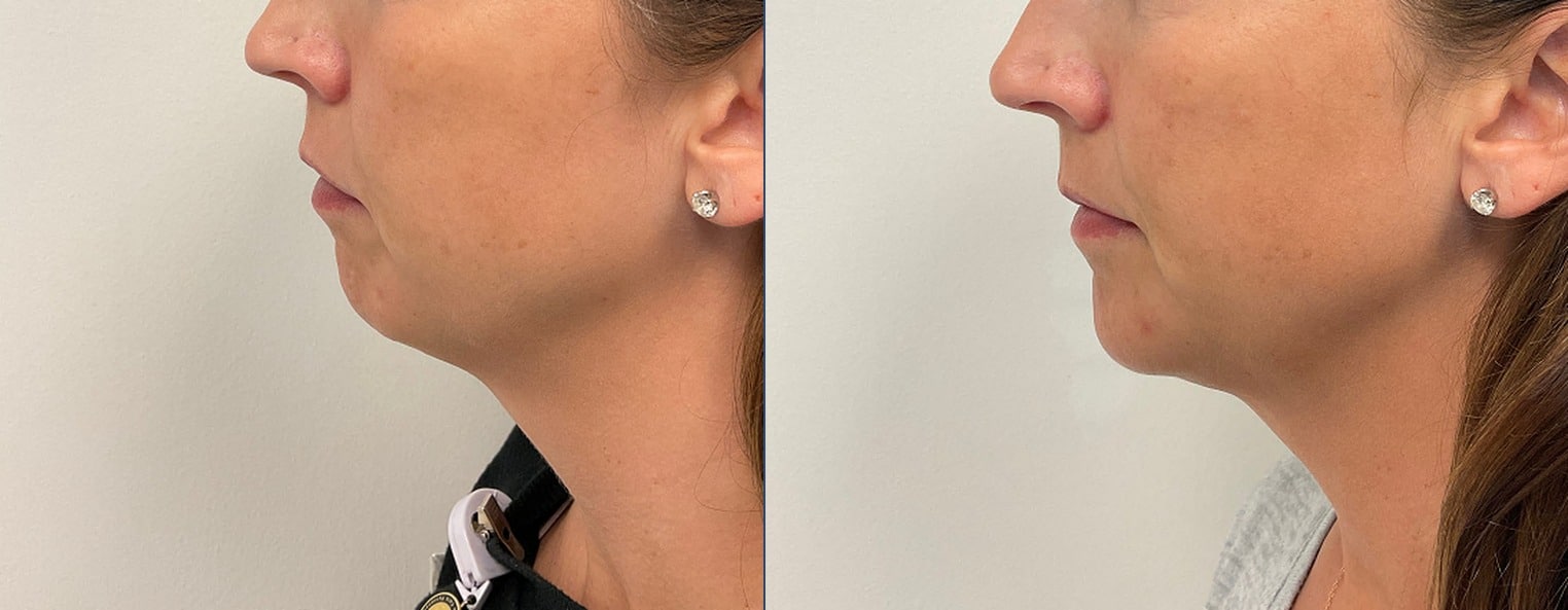 Chin filler before and after, side profile — Chrissy Handly, Case 67, Cool Springs Plastic Surgery