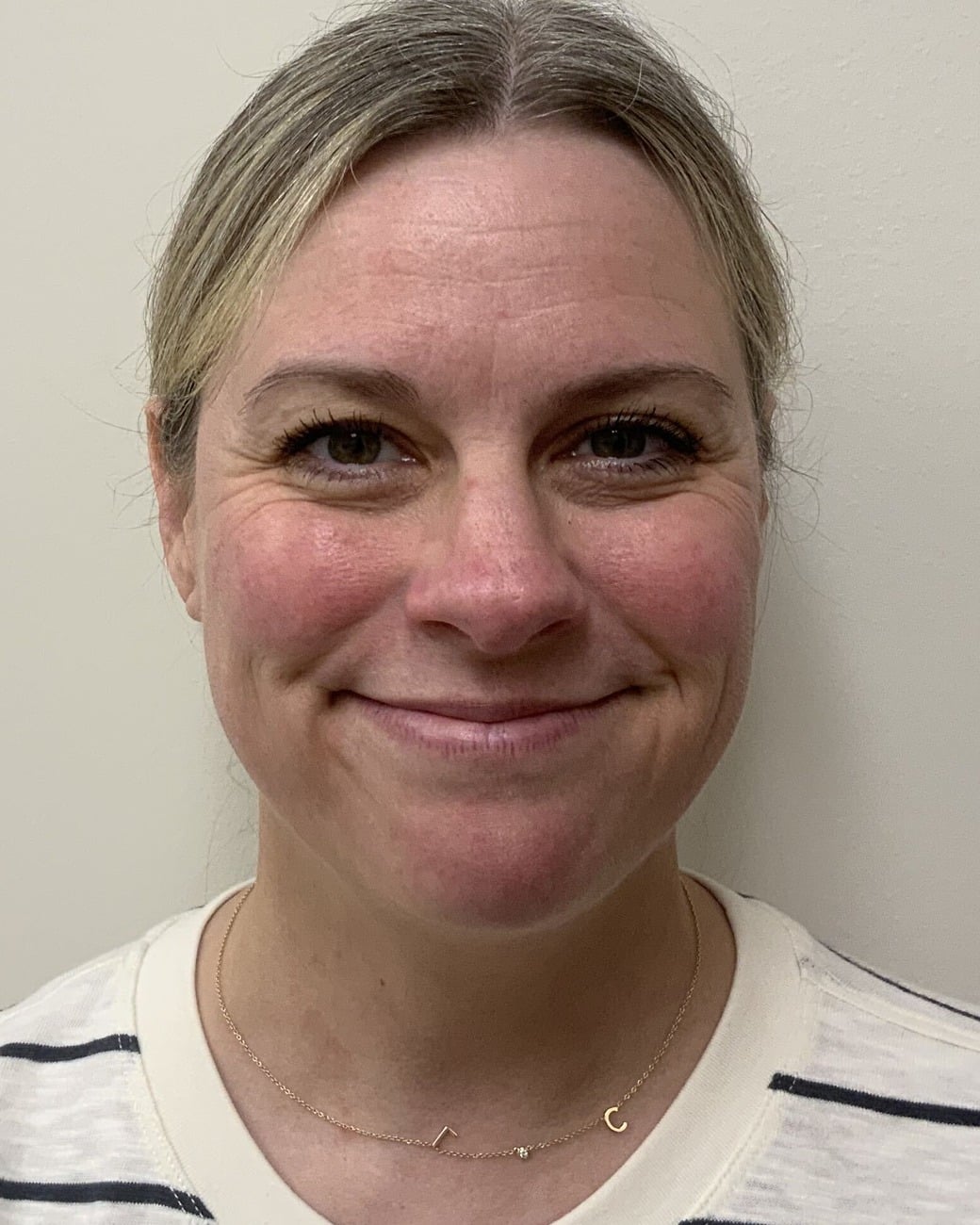 Before Daxxify injectable treatment at Cool Springs Plastic Surgery in Nashville