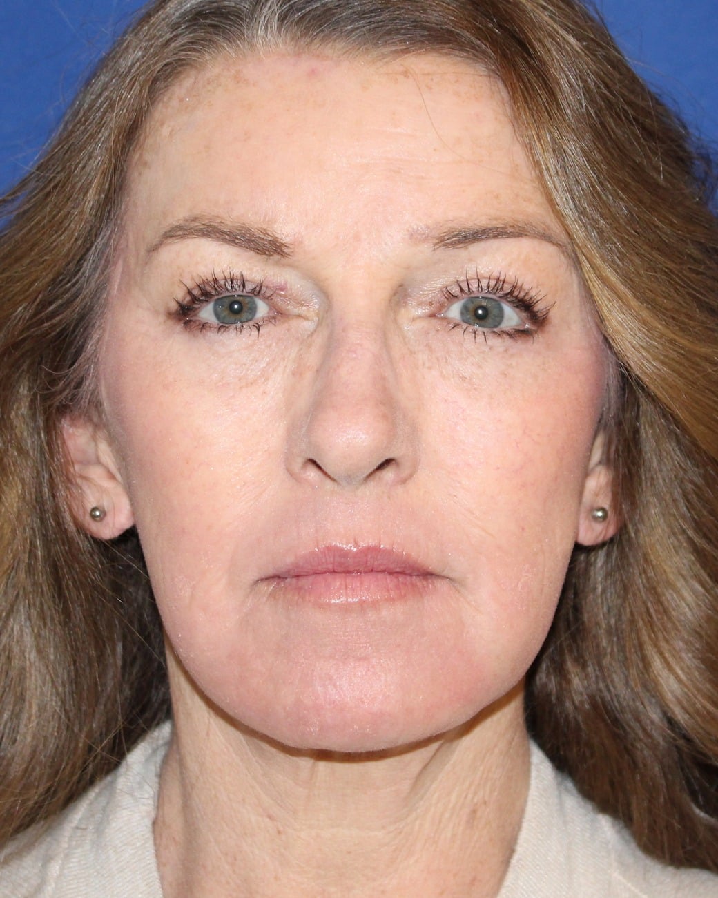 After facelift showing a firmer jawline and smoother neck at Cool Springs Plastic Surgery in Nashville