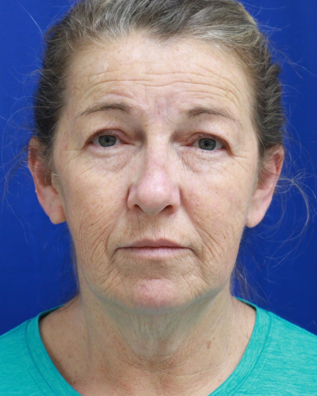 Before facelift showing jowls and loose neck skin at Cool Springs Plastic Surgery in Nashville