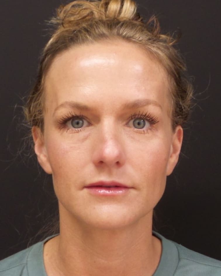 Facial balancing (filler and Botox) after photo of CSPS patient — Brentwood TN