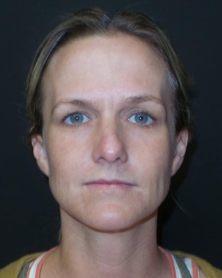 Facial balancing (filler and Botox) before photo of CSPS patient — Brentwood TN