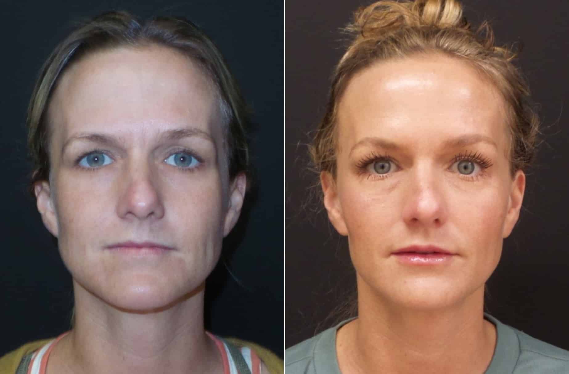 Facial balancing before and after photos — CSPS patient with Kaylan Lady, FNP-C — Brentwood TN