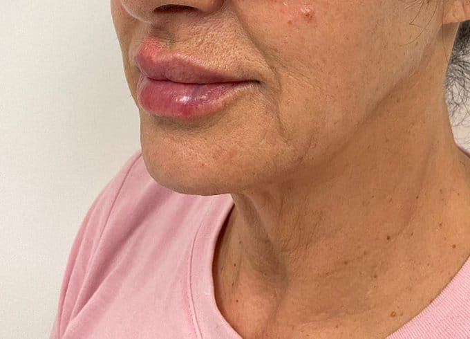 Facial filler after photo, oblique lower-face view — Case 55, Cool Springs Plastic Surgery, Brentwood TN