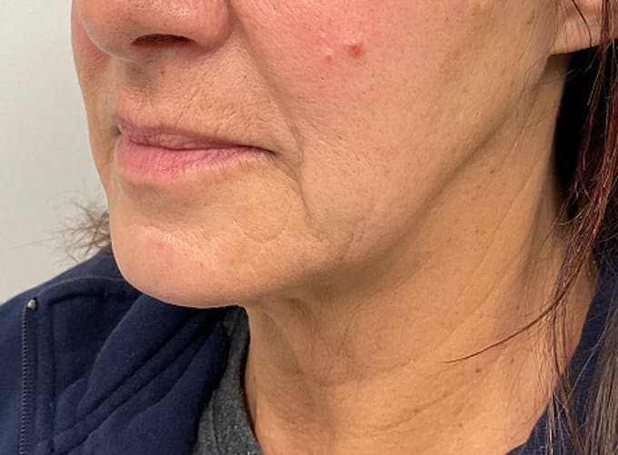 Facial filler before photo, oblique lower-face view — Case 55, Cool Springs Plastic Surgery, Brentwood TN