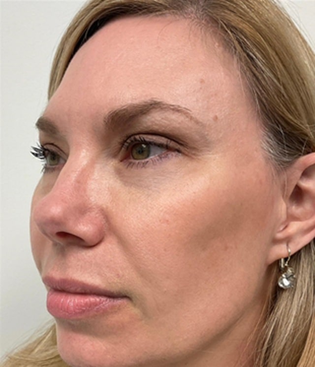Midface filler after photo — Chrissy Handly, Case 73, Cool Springs Plastic Surgery, Brentwood TN