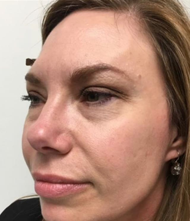 Midface filler before photo — Chrissy Handly, Case 73, Cool Springs Plastic Surgery, Brentwood TN