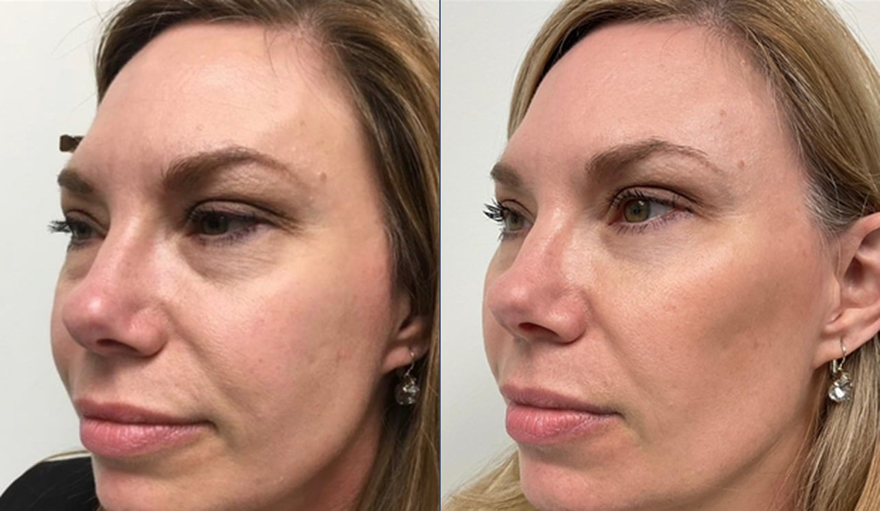 Midface filler before and after — Chrissy Handly, Case 73, Cool Springs Plastic Surgery