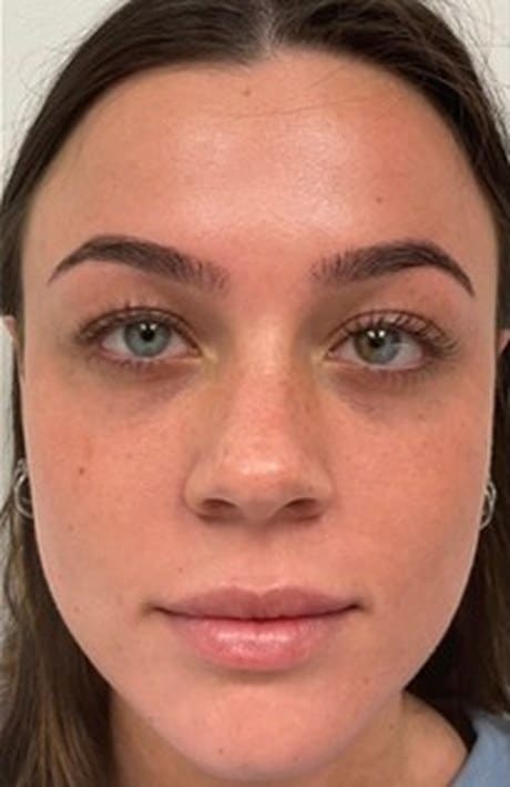 Cheek, lip and tear trough filler after photo, front view — Case 74, Cool Springs Plastic Surgery, Brentwood TN