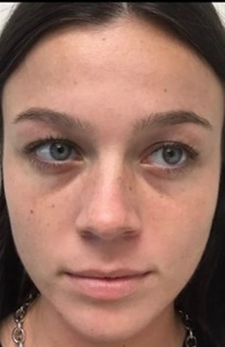 Cheek, lip and tear trough filler before photo, front view — Case 74, Cool Springs Plastic Surgery, Brentwood TN