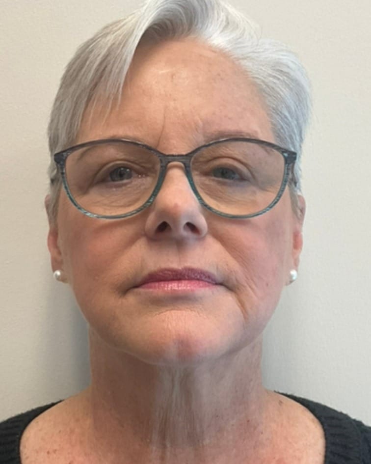 Dermal filler after photo of CSPS patient — softened marionette lines — Brentwood TN