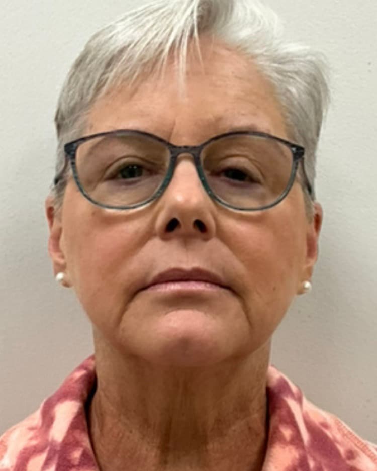 Dermal filler before photo of CSPS patient — marionette lines — Brentwood TN