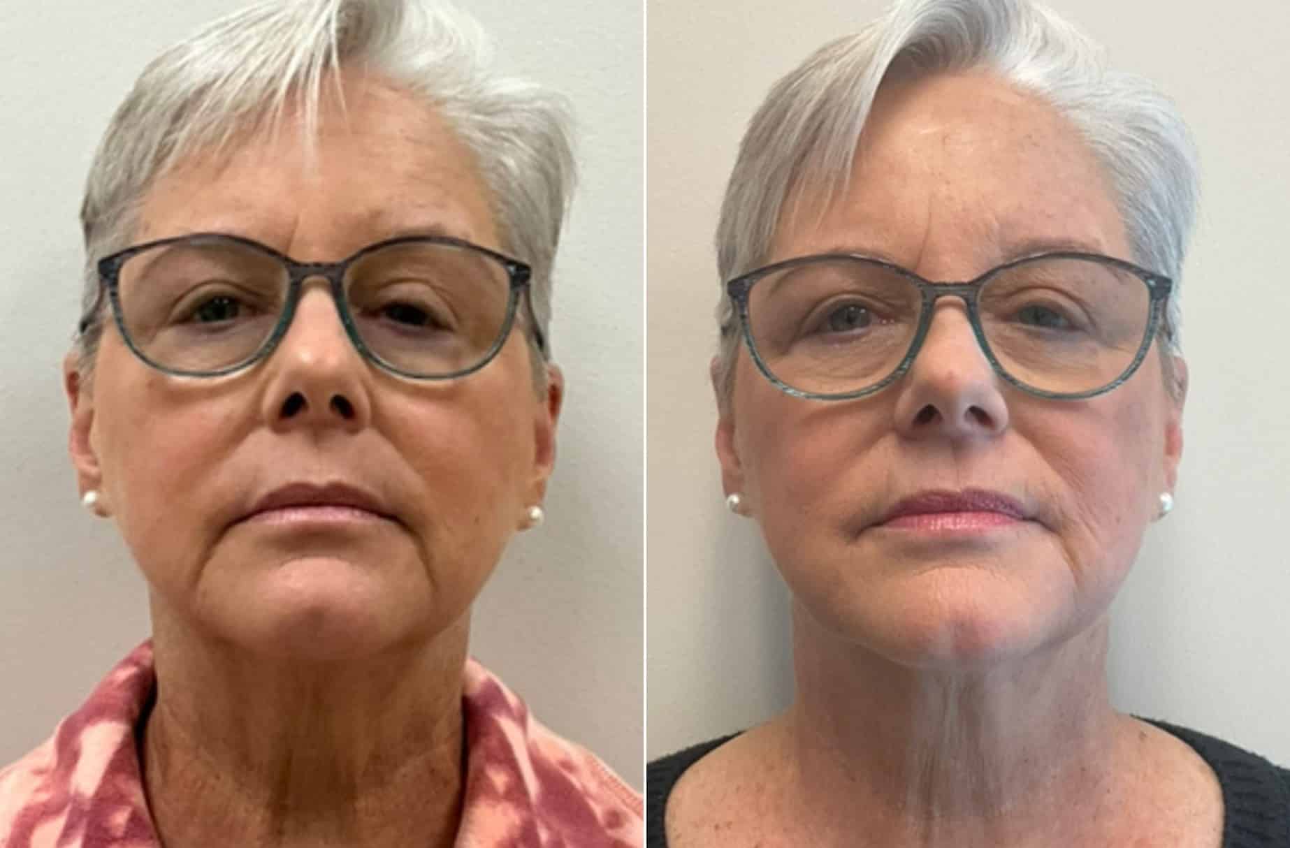 Dermal filler before and after photos — CSPS patient with Laura Sonn, RN — Brentwood TN