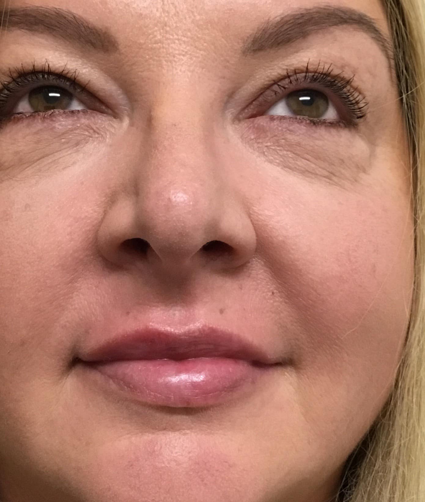 Filler after photo — Michele Bailey, Case 88, Cool Springs Plastic Surgery, Brentwood TN