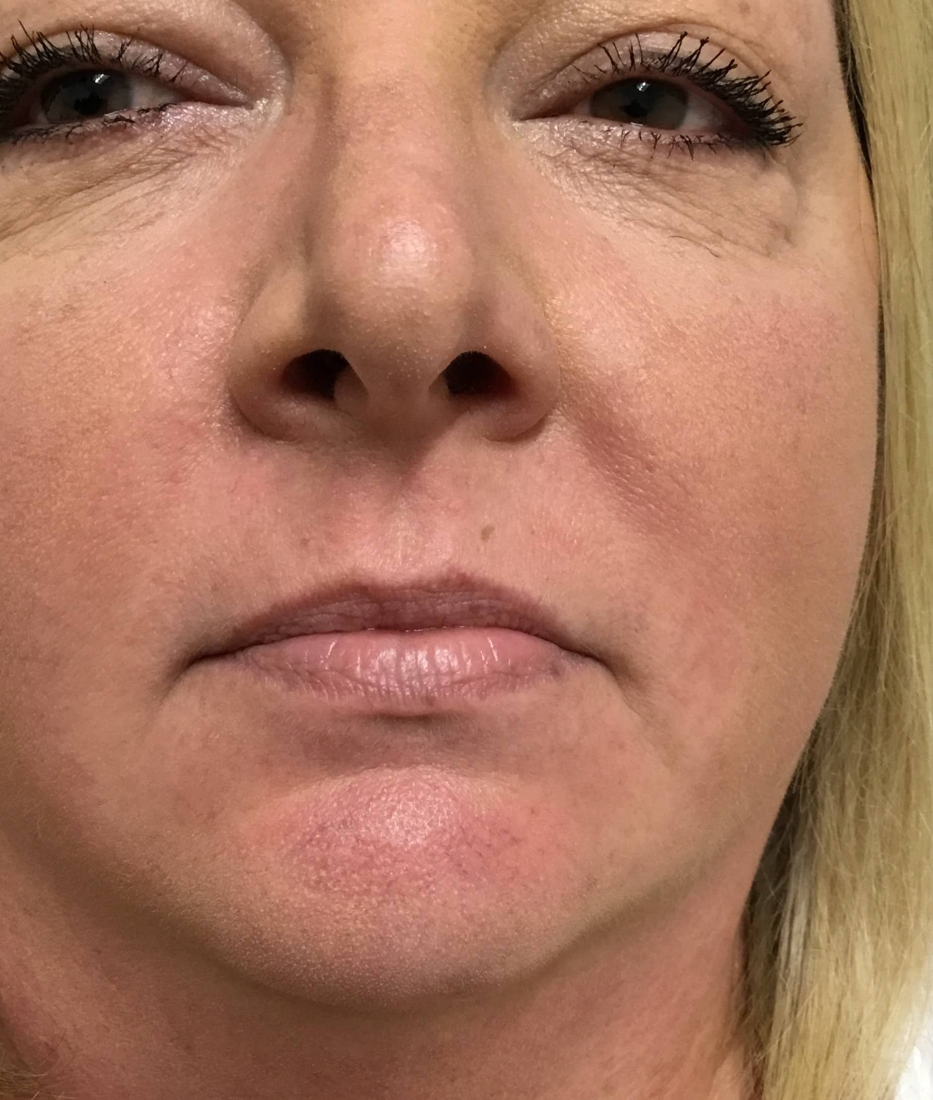 Filler before photo — Michele Bailey, Case 88, Cool Springs Plastic Surgery, Brentwood TN