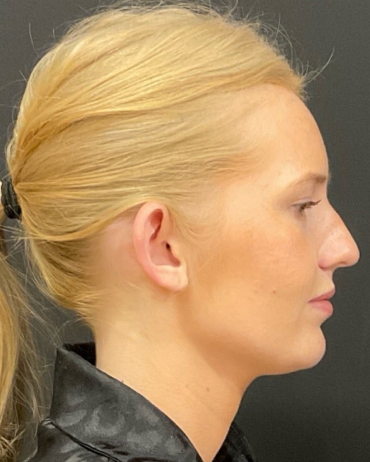 Jawline filler after photo of CSPS patient — sharper jawline — Brentwood TN