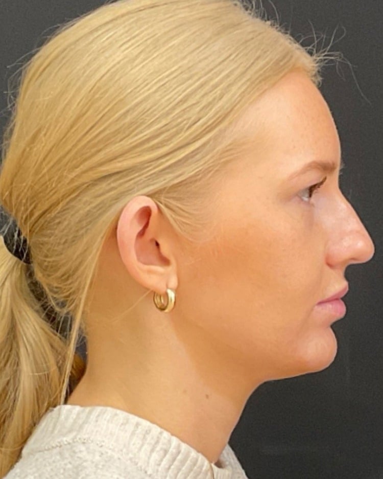 Jawline filler before photo of CSPS patient — jawline contour — Brentwood TN
