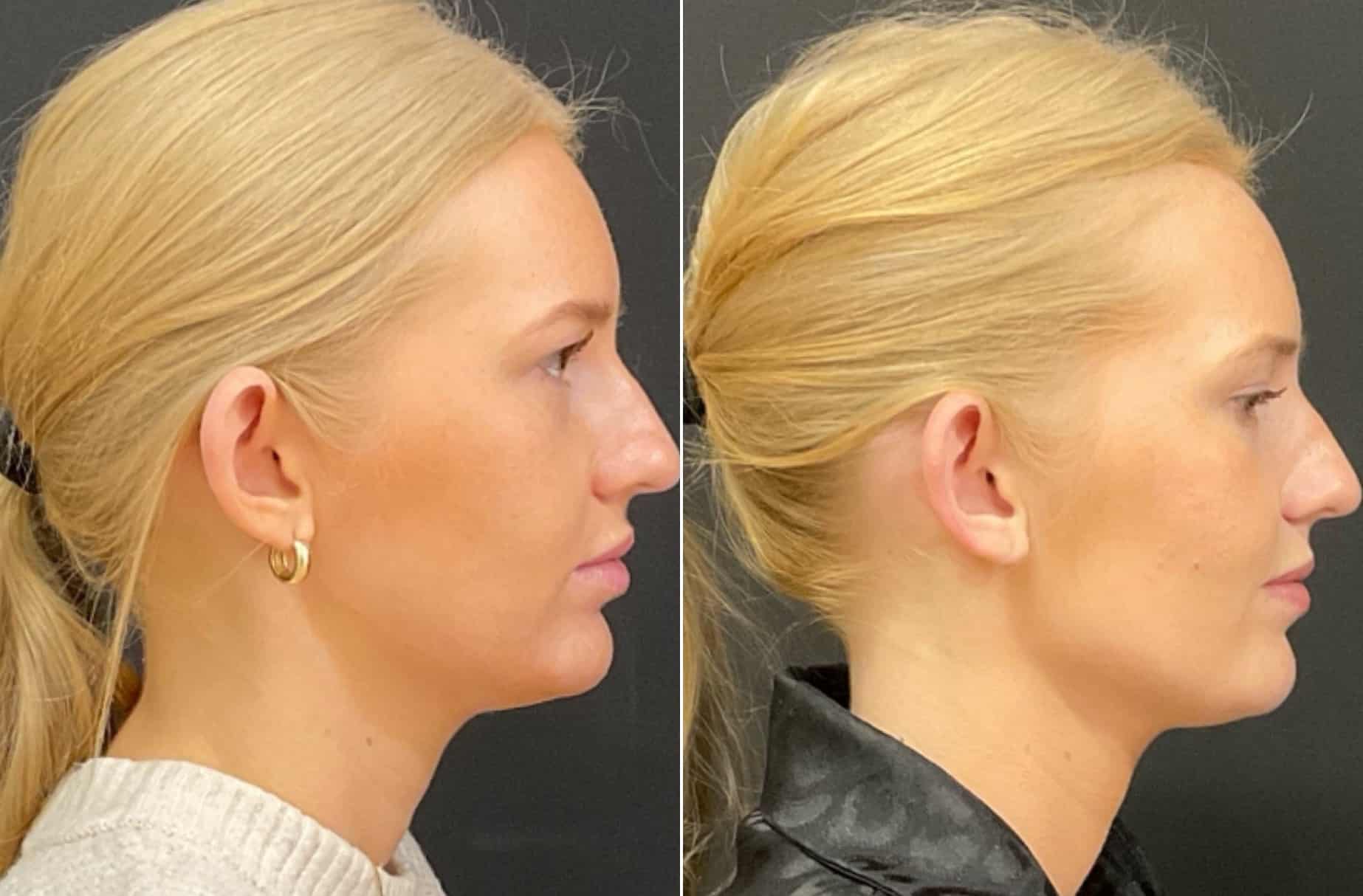 Jawline filler before and after photos — CSPS patient with Kaylan Lady, FNP-C — Brentwood TN