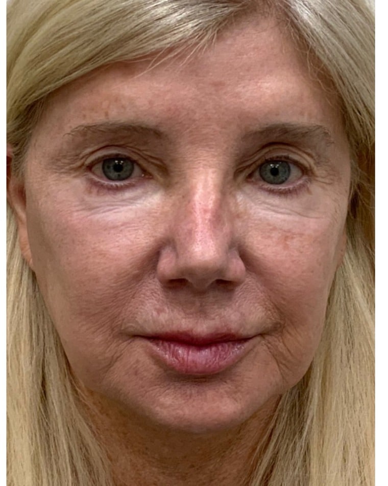 After Halo and BBL laser treatment showing more even skin tone and reduced discoloration at Cool Springs Plastic Surgery in Nashville