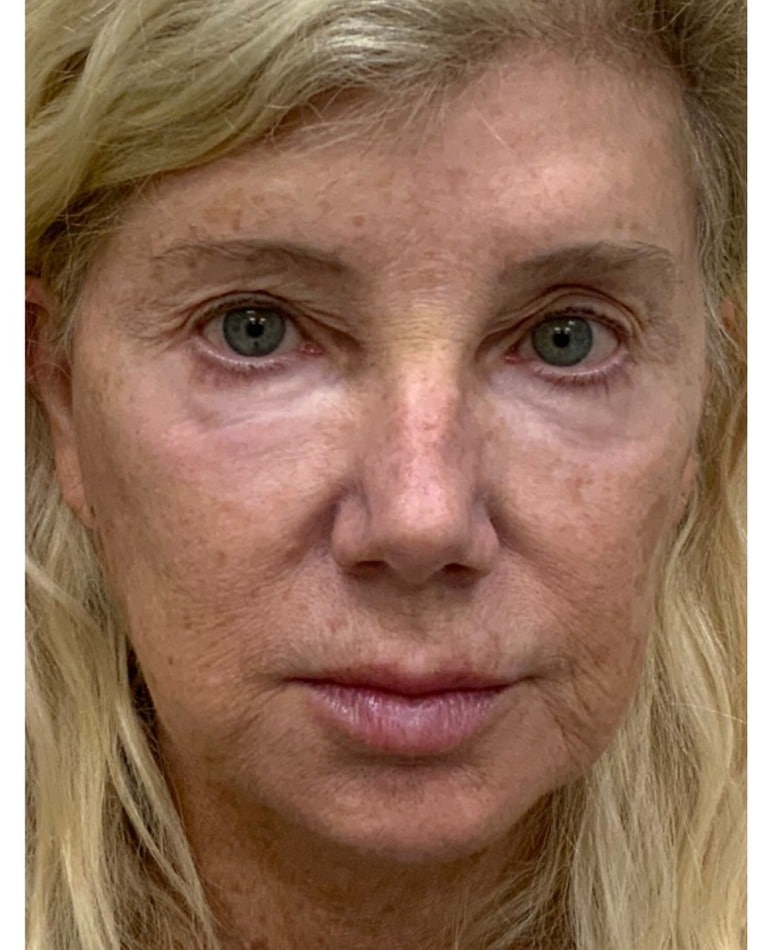 Before Halo and BBL laser treatment for skin discoloration and uneven tone at Cool Springs Plastic Surgery in Nashville