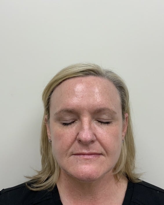 After BBL laser treatment showing clearer, more even skin at Cool Springs Plastic Surgery in Nashville