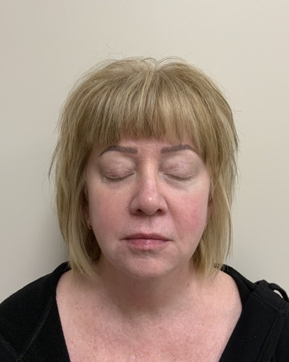 After BBL laser treatment showing reduced redness, smoother skin at Cool Springs Plastic Surgery in Nashville