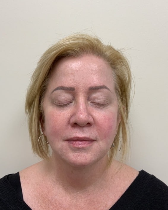 Before BBL laser treatment for redness and texture at Cool Springs Plastic Surgery in Nashville