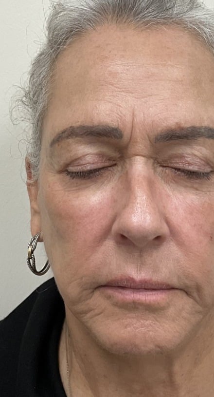 Laser skin treatment after photo — Destiny Berger, Case 111, Cool Springs Plastic Surgery, Brentwood TN