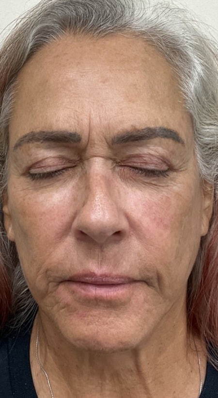 Laser skin treatment before photo — Destiny Berger, Case 111, Cool Springs Plastic Surgery, Brentwood TN
