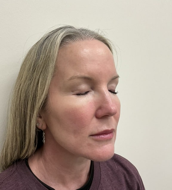 Laser skin treatment after photo — Destiny Berger, Case 97, Cool Springs Plastic Surgery, Brentwood TN