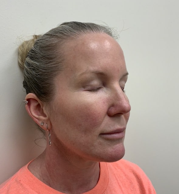 Laser skin treatment before photo — Destiny Berger, Case 97, Cool Springs Plastic Surgery, Brentwood TN
