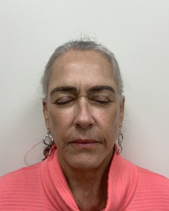 Moxi laser after photo of CSPS patient — smoother, more even skin — 3 sessions — Brentwood TN