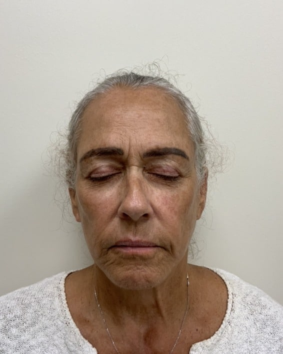 Moxi laser before photo of CSPS patient — uneven skin tone and texture — Brentwood TN