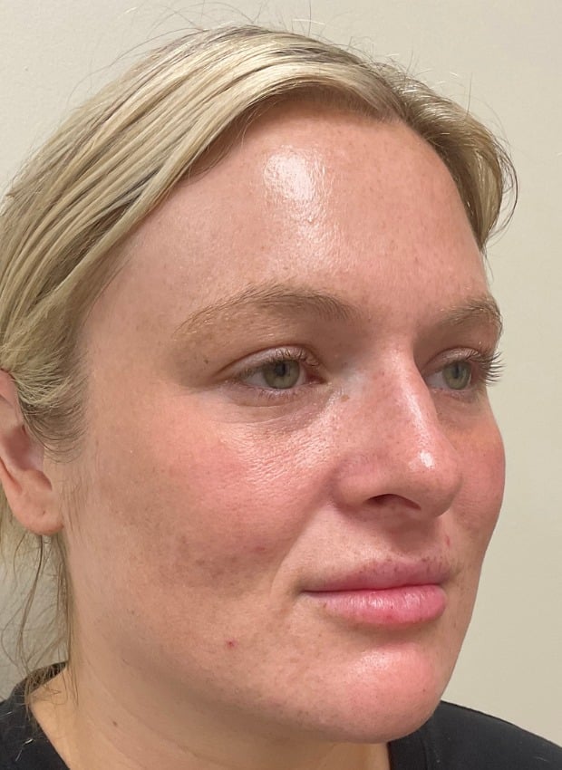 Laser skin treatment after photo — Natalie Moros, Case 100, Cool Springs Plastic Surgery, Brentwood TN