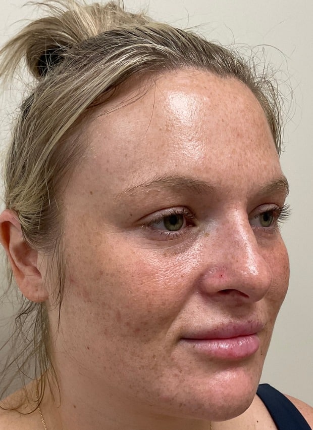 Laser skin treatment before photo — Natalie Moros, Case 100, Cool Springs Plastic Surgery, Brentwood TN