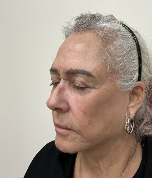 Moxi laser after photo, left oblique view — Case 111, Cool Springs Plastic Surgery, Brentwood TN