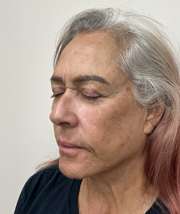 Moxi laser before photo, left oblique view — Case 111, Cool Springs Plastic Surgery, Brentwood TN