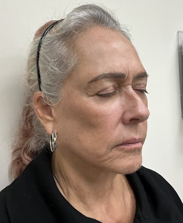 Moxi laser after photo, right oblique view — Case 111, Cool Springs Plastic Surgery, Brentwood TN