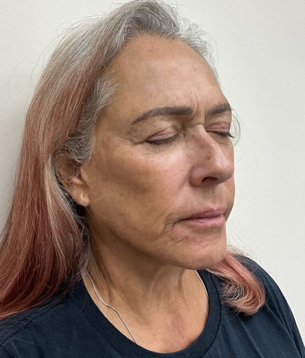 Moxi laser before photo, right oblique view — Case 111, Cool Springs Plastic Surgery, Brentwood TN
