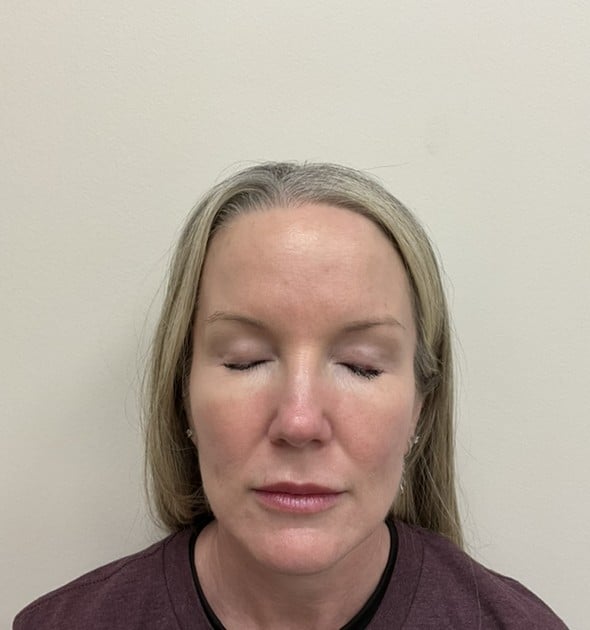 Laser skin resurfacing after photo, frontal view — Case 97, Cool Springs Plastic Surgery, Brentwood TN