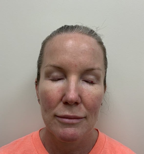 Laser skin resurfacing before photo, frontal view — Case 97, Cool Springs Plastic Surgery, Brentwood TN